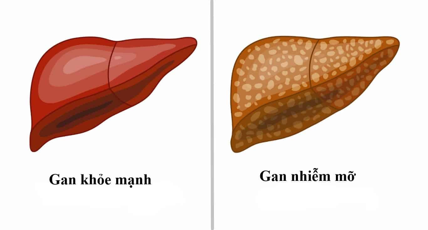 Bé trai 9 tuổi đã bị xơ gan, bác sĩ khuyến cáo thay đổi 1 điều trong ăn uống nhưng cha mẹ bỏ qua khiến bệnh càng nặng- Ảnh 3. Bé trai 9 tuổi đã bị xơ gan, bác sĩ khuyến cáo thay đổi 1 điều trong ăn uống nhưng cha mẹ bỏ qua khiến bệnh càng nặng- Ảnh 3.