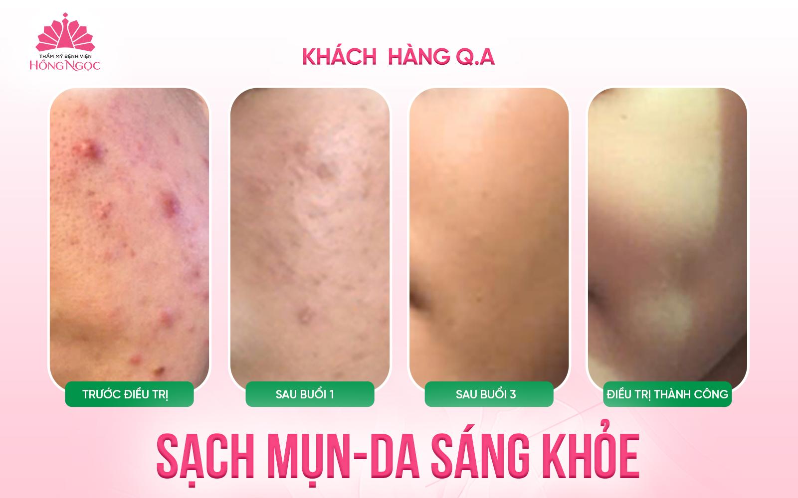 Làn da tuổi dậy thì - Chú ý đừng để quảng cáo "đẹp rẻ" dẫn lối sai cách- Ảnh 1. Làn da tuổi dậy thì - Chú ý đừng để quảng cáo "đẹp rẻ" dẫn lối sai cách- Ảnh 1.