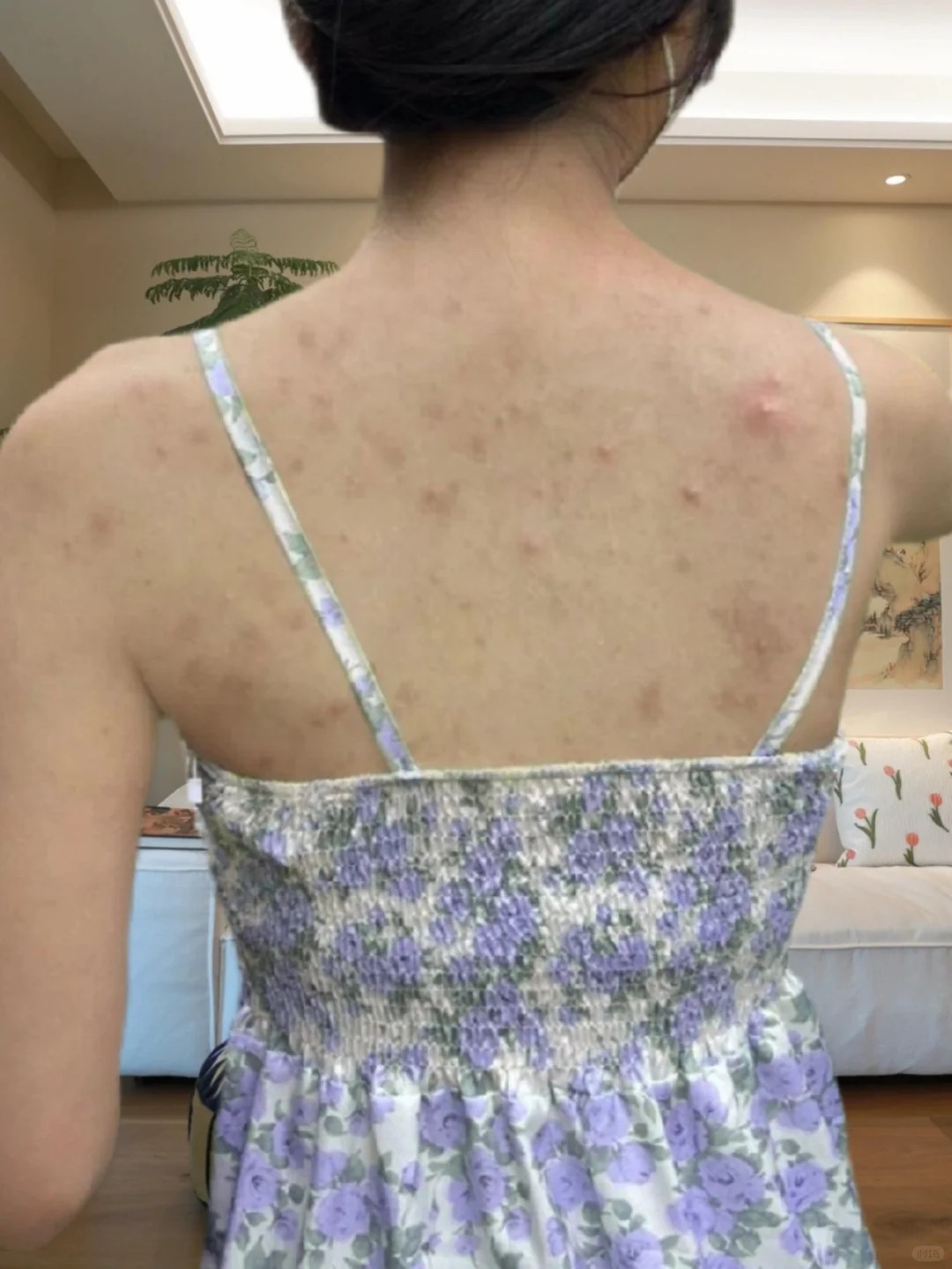 Từ mụn sần sùi, lưng tôi đã "nhẵn nhụi" hoàn toàn nhờ món đồ rẻ tiền này!- Ảnh 2. Từ mụn sần sùi, lưng tôi đã "nhẵn nhụi" hoàn toàn nhờ món đồ rẻ tiền này!- Ảnh 2.