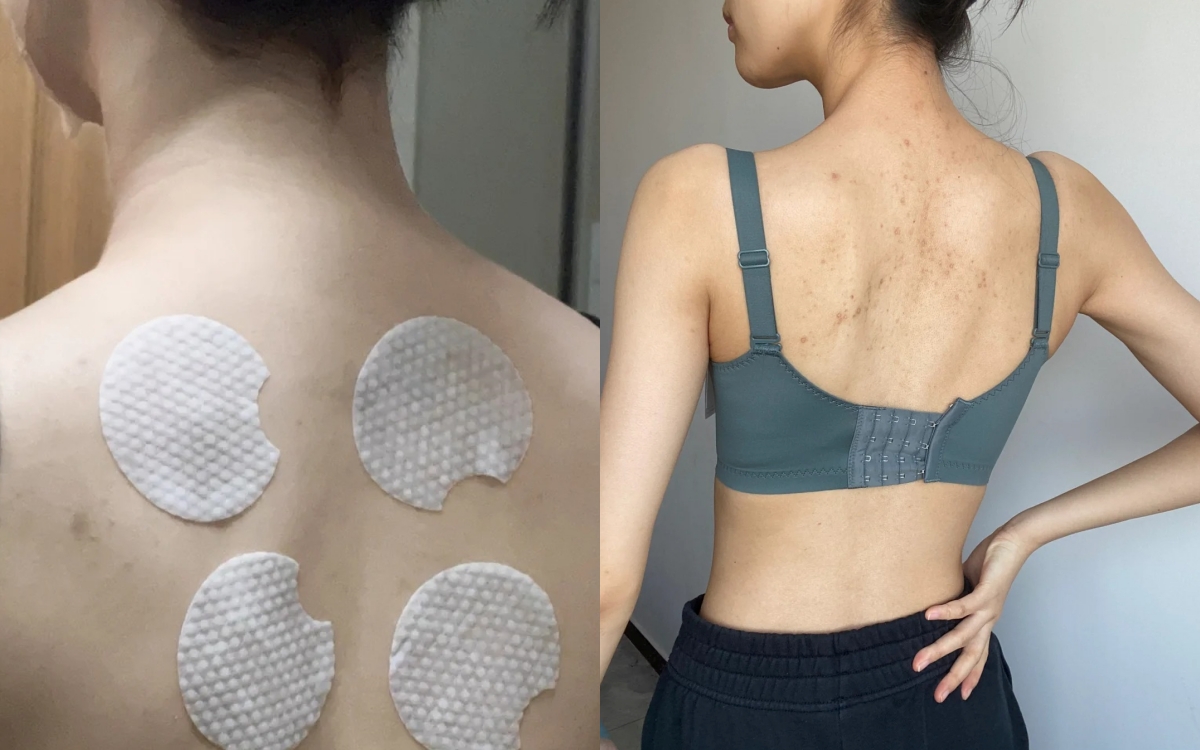 Từ mụn sần sùi, lưng tôi đã "nhẵn nhụi" hoàn toàn nhờ món đồ rẻ tiền này!- Ảnh 1. Từ mụn sần sùi, lưng tôi đã "nhẵn nhụi" hoàn toàn nhờ món đồ rẻ tiền này!- Ảnh 1.