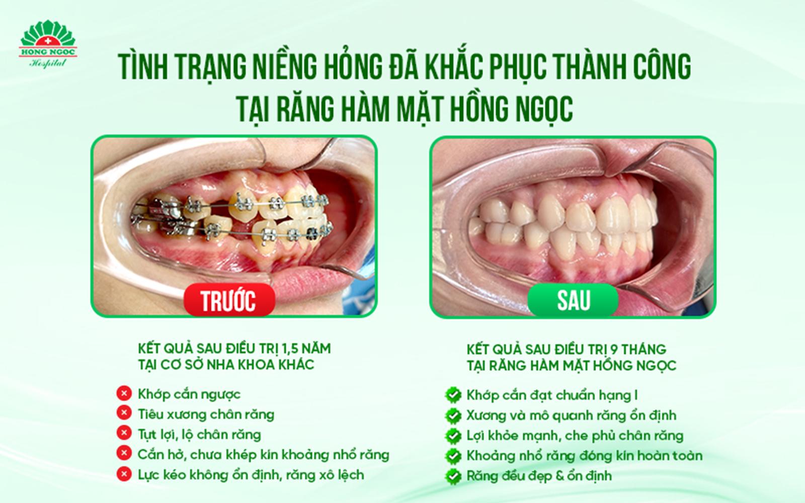 Niềng chuẩn không chỉ để đẹp mà để Gen Z cười chill đúng chất- Ảnh 2.