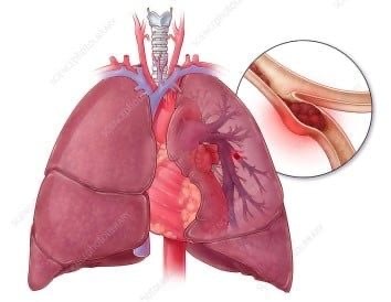 Cứu sống người bệnh thuyên tắc phổi nguy kịch do sử dụng thuốc tránh thai kéo dài - Ảnh 1. Cứu sống người bệnh thuyên tắc phổi nguy kịch do sử dụng thuốc tránh thai kéo dài - Ảnh 1.