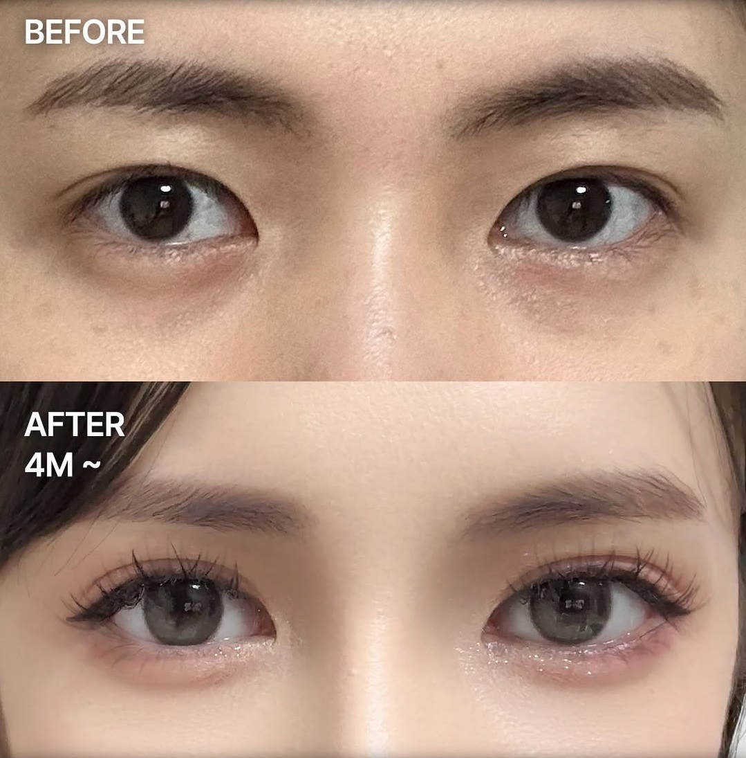 5 điều bạn cần biết trước khi quyết định nâng mũi Hàn Quốc- Ảnh 3. 5 điều bạn cần biết trước khi quyết định nâng mũi Hàn Quốc- Ảnh 3.