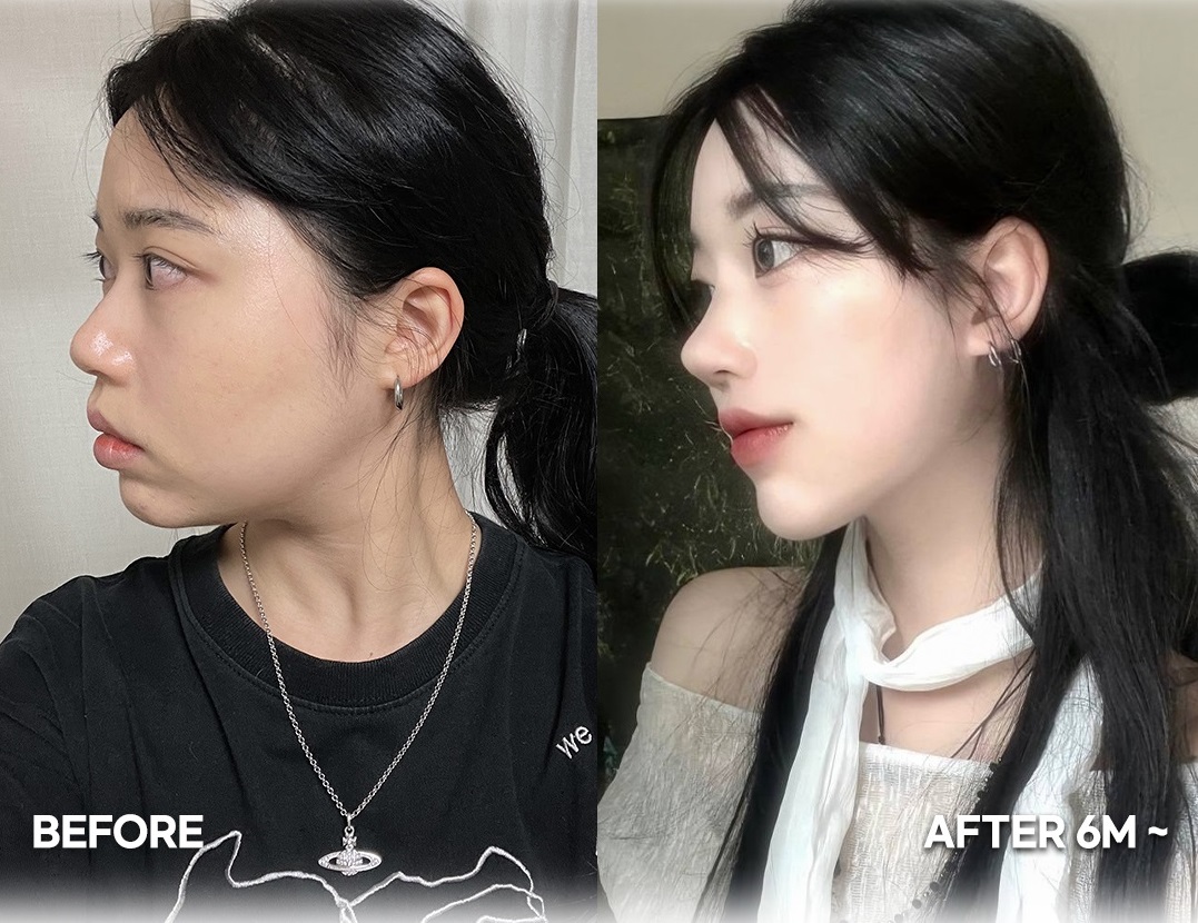 5 điều bạn cần biết trước khi quyết định nâng mũi Hàn Quốc- Ảnh 4. 5 điều bạn cần biết trước khi quyết định nâng mũi Hàn Quốc- Ảnh 4.