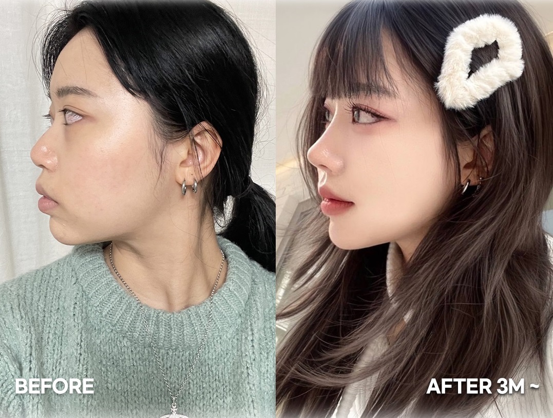 5 điều bạn cần biết trước khi quyết định nâng mũi Hàn Quốc- Ảnh 5. 5 điều bạn cần biết trước khi quyết định nâng mũi Hàn Quốc- Ảnh 5.