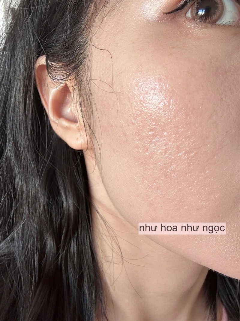 Tôi đã trẻ hóa da thành công nhờ collagen, mất đúng 2 năm để thay đổi làn da sẹo rỗ- Ảnh 2. Tôi đã trẻ hóa truc tiep bong da vtv6 thành công nhờ collagen, mất đúng 2 năm để thay đổi làn truc tiep bong da vtv6 sẹo rỗ- Ảnh 2.