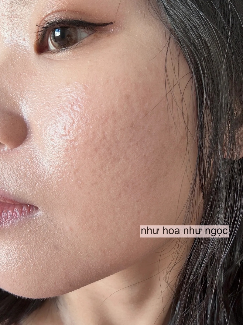 Tôi đã trẻ hóa da thành công nhờ collagen, mất đúng 2 năm để thay đổi làn da sẹo rỗ- Ảnh 1. Tôi đã trẻ hóa truc tiep bong da vtv6 thành công nhờ collagen, mất đúng 2 năm để thay đổi làn truc tiep bong da vtv6 sẹo rỗ- Ảnh 1.