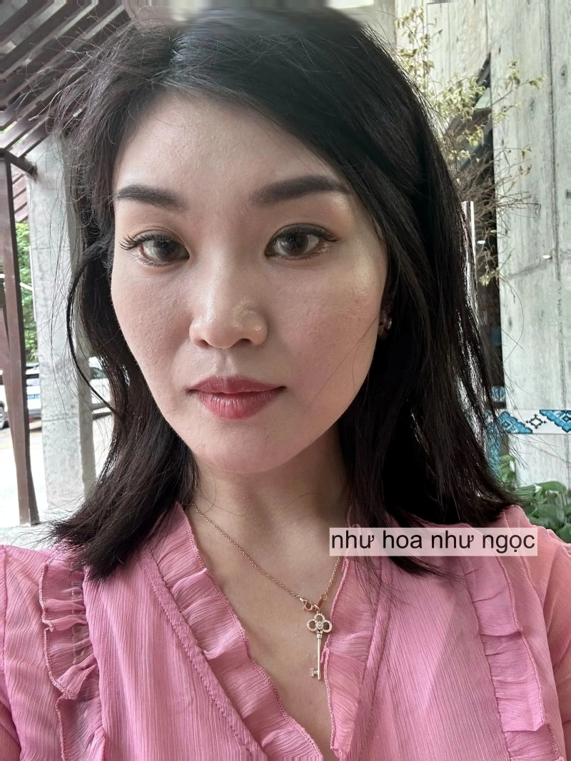 Tôi đã trẻ hóa da thành công nhờ collagen, mất đúng 2 năm để thay đổi làn da sẹo rỗ- Ảnh 5. Tôi đã trẻ hóa truc tiep bong da vtv6 thành công nhờ collagen, mất đúng 2 năm để thay đổi làn truc tiep bong da vtv6 sẹo rỗ- Ảnh 5.