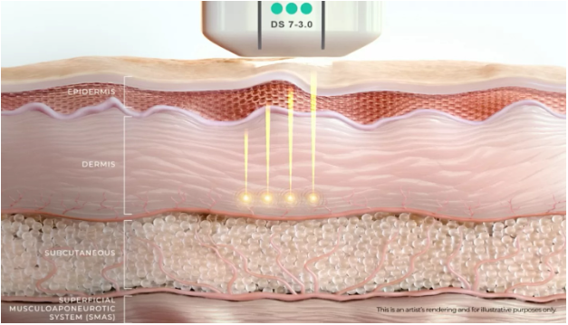 Ultherapy PRIME – Thời kỳ mới của trẻ hóa da không xâm lấn- Ảnh 2. Ultherapy PRIME – Thời kỳ mới của trẻ hóa da không xâm lấn- Ảnh 2.