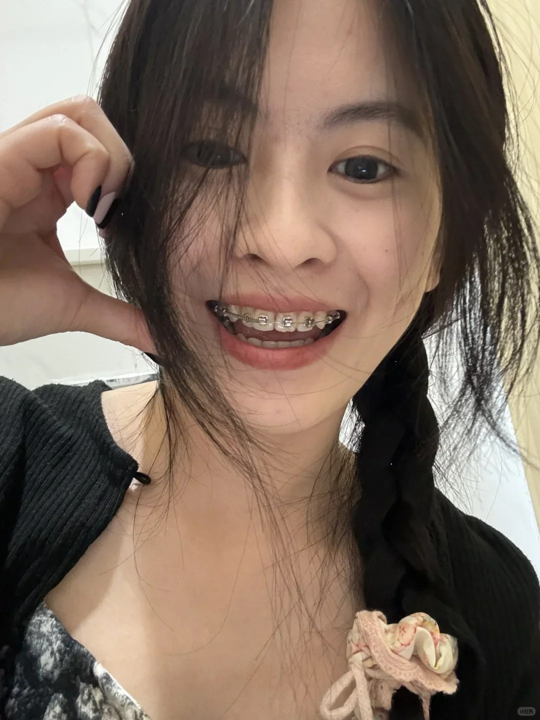 Chỉnh nha kiểu Meaw - Geaw: Vì sao được giới trẻ săn đón?- Ảnh 8. Chỉnh nha kiểu Meaw - Geaw: Vì sao được giới trẻ săn đón?- Ảnh 8.