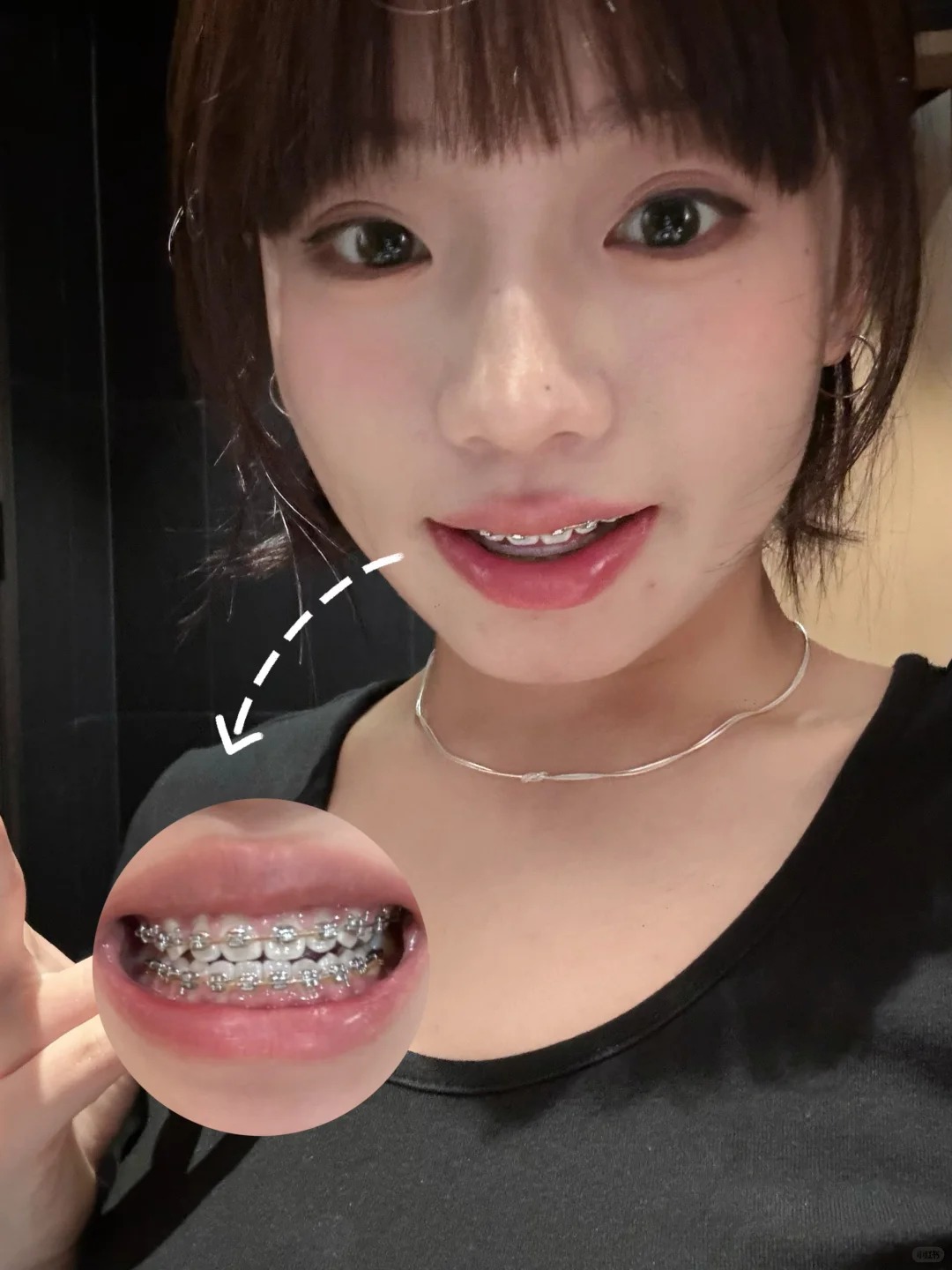 Chỉnh nha kiểu Meaw - Geaw: Vì sao được giới trẻ săn đón?- Ảnh 9. Chỉnh nha kiểu Meaw - Geaw: Vì sao được giới trẻ săn đón?- Ảnh 9.