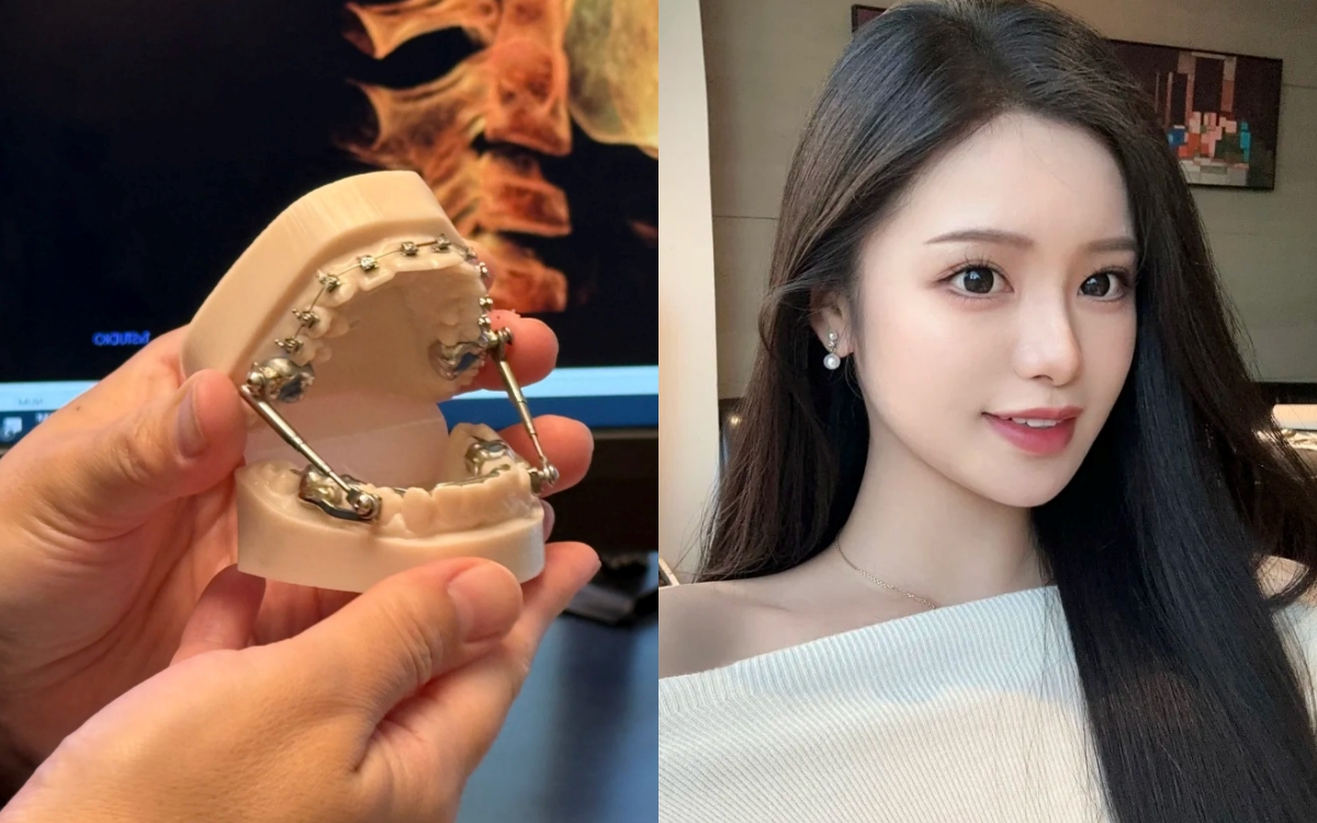 Chỉnh nha kiểu Meaw - Geaw: Vì sao được giới trẻ săn đón?- Ảnh 1. Chỉnh nha kiểu Meaw - Geaw: Vì sao được giới trẻ săn đón?- Ảnh 1.