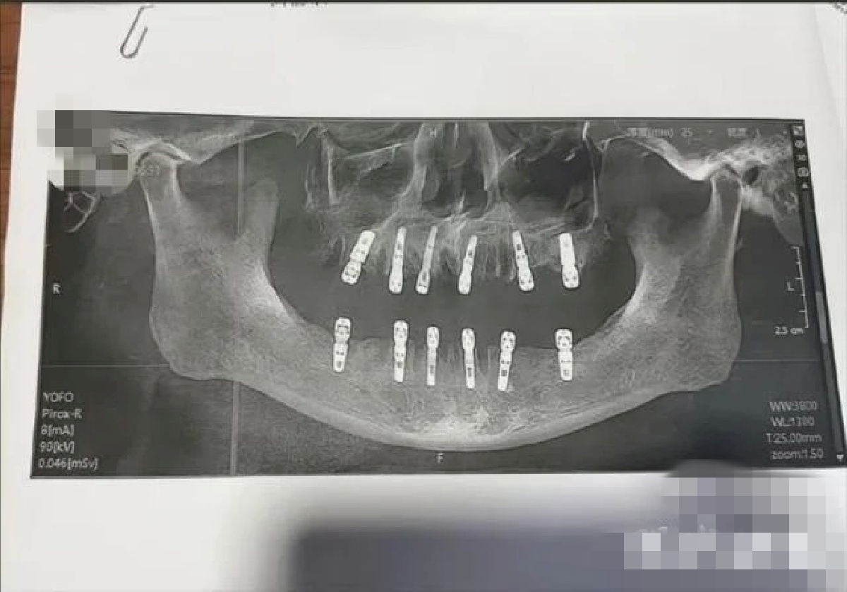 Cụ ông 77 tuổi qua đời sau khi cấy 6 implant và nhổ 12 răng: Có phải càng nhiều tuổi càng không nên nhổ răng, cấy implant?- Ảnh 2. Cụ ông 77 tuổi qua đời sau khi cấy 6 implant và nhổ 12 răng: Có phải càng nhiều tuổi càng không nên nhổ răng, cấy implant?- Ảnh 2.
