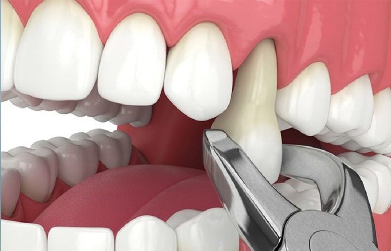 Cụ ông 77 tuổi qua đời sau khi cấy 6 implant và nhổ 12 răng: Có phải càng nhiều tuổi càng không nên nhổ răng, cấy implant?- Ảnh 4. Cụ ông 77 tuổi qua đời sau khi cấy 6 implant và nhổ 12 răng: Có phải càng nhiều tuổi càng không nên nhổ răng, cấy implant?- Ảnh 4.