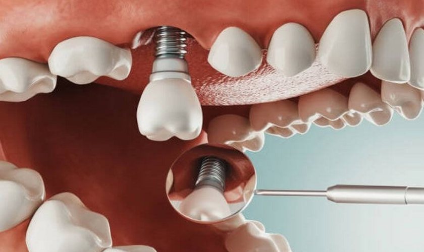 Cụ ông 77 tuổi qua đời sau khi cấy 6 implant và nhổ 12 răng: Có phải càng nhiều tuổi càng không nên nhổ răng, cấy implant?- Ảnh 5. Cụ ông 77 tuổi qua đời sau khi cấy 6 implant và nhổ 12 răng: Có phải càng nhiều tuổi càng không nên nhổ răng, cấy implant?- Ảnh 5.