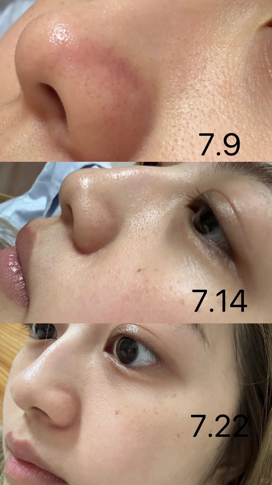 Lỗ chân lông nhỏ đi thấy rõ sau 1 tháng cô nàng này dùng bộ đôi serum dưỡng da bình dân của Hàn- Ảnh 6. Lỗ chân lông nhỏ đi thấy rõ sau 1 tháng cô nàng này dùng bộ đôi serum dưỡng da bình dân của Hàn- Ảnh 6.