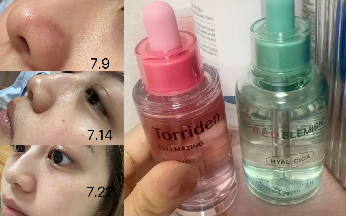Lỗ chân lông nhỏ đi thấy rõ sau 1 tháng cô nàng này dùng bộ đôi serum dưỡng da bình dân của Hàn- Ảnh 2. Lỗ chân lông nhỏ đi thấy rõ sau 1 tháng cô nàng này dùng bộ đôi serum dưỡng da bình dân của Hàn- Ảnh 2.