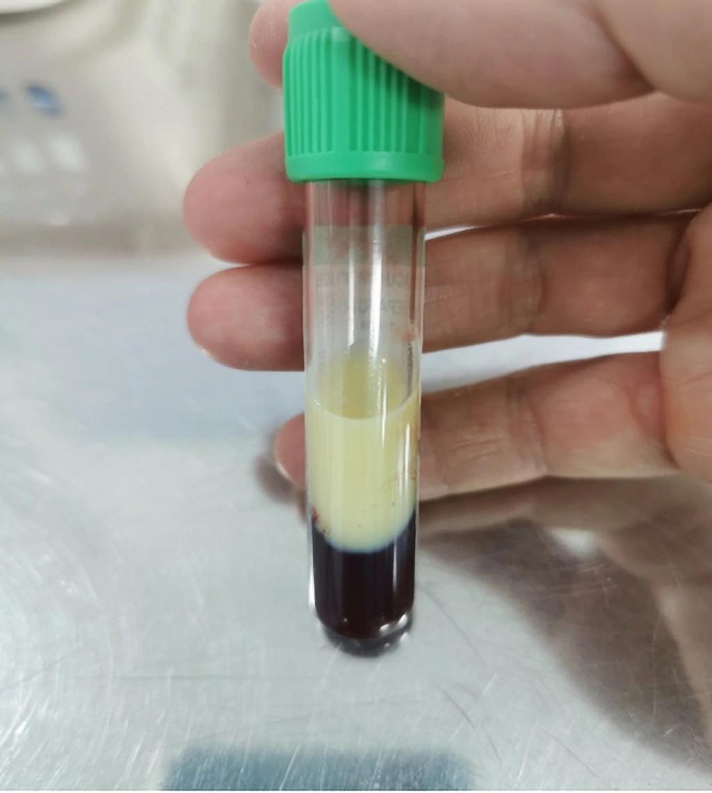 Người phụ nữ 42 tuổi máu nhiễm mỡ trắng xóa, nguy cơ viêm tụy cấp vì sáng nào cũng uống thứ nước nhiều người Việt mê mẩn- Ảnh 1. Người phụ nữ 42 tuổi máu nhiễm mỡ trắng xóa, nguy cơ viêm tụy cấp vì sáng nào cũng uống thứ nước nhiều người Việt mê mẩn- Ảnh 1.