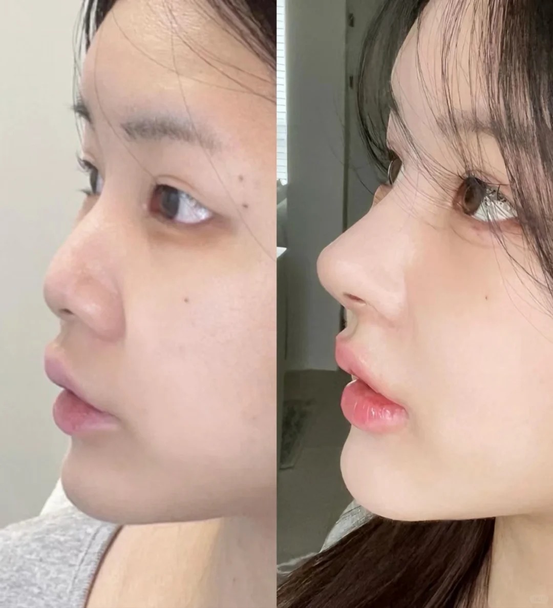 Nâng mũi giá rẻ: Những rủi link bong da truc tiep tiềm ẩn và lời khuyên từ chuyên gia- Ảnh 4.