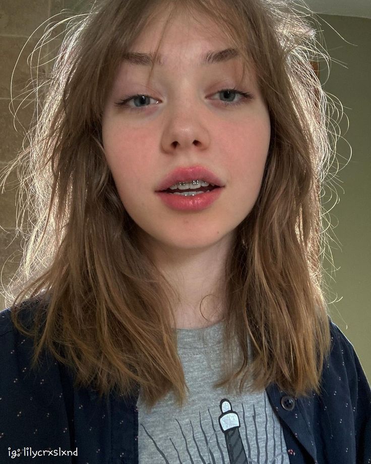 Niềng răng sai cách: Gây lệch mặt, sưng hàm, đau khớp- Ảnh 3. Niềng răng sai cách: Gây lệch mặt, sưng hàm, đau khớp- Ảnh 3.