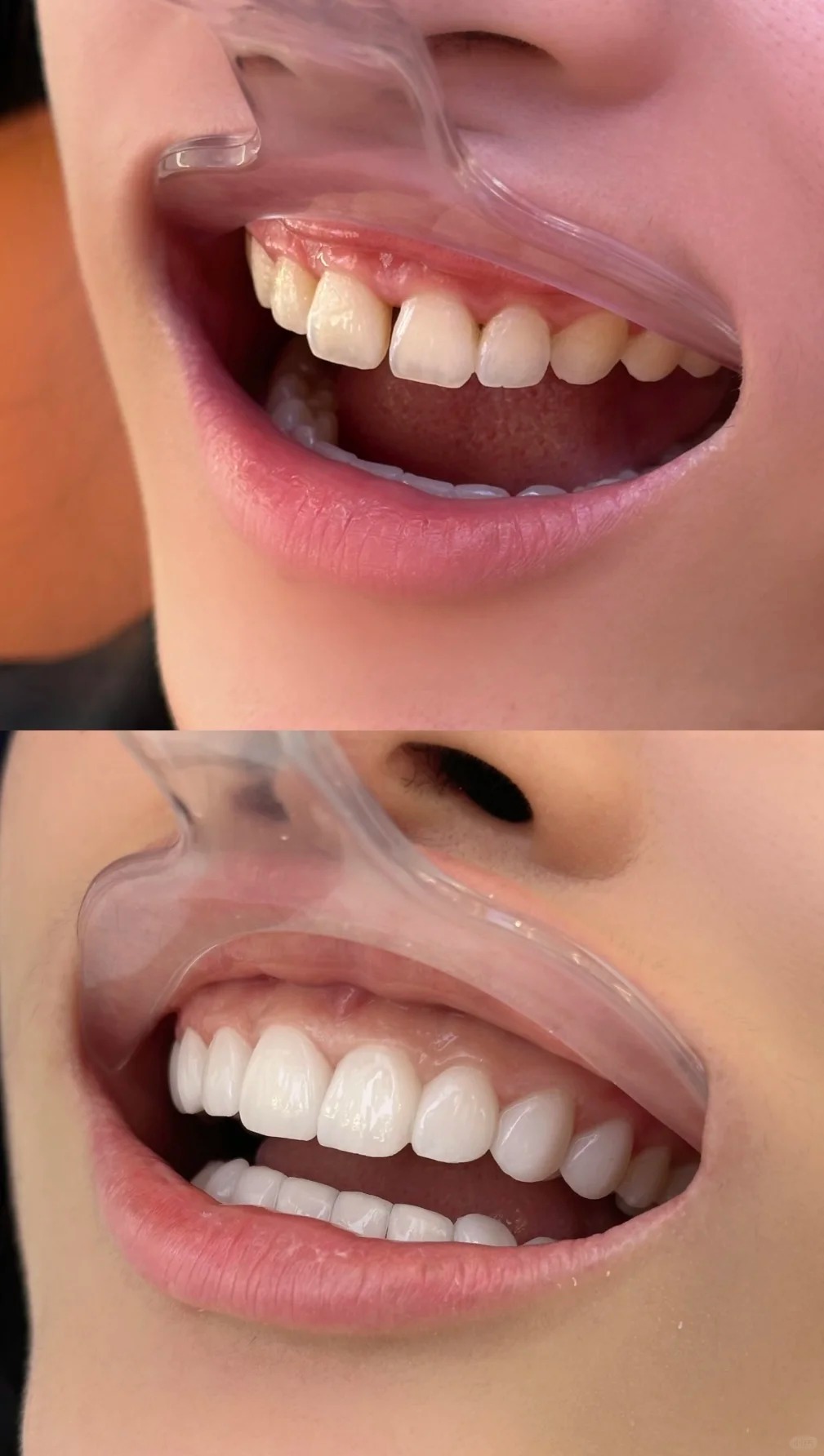 Đừng để răng sứ "làm hỏng nụ cười" khi mắc phải những sai lầm cơ bản này- Ảnh 4. Đừng để răng sứ "làm hỏng nụ cười" khi mắc phải những sai lầm cơ bản này- Ảnh 4.