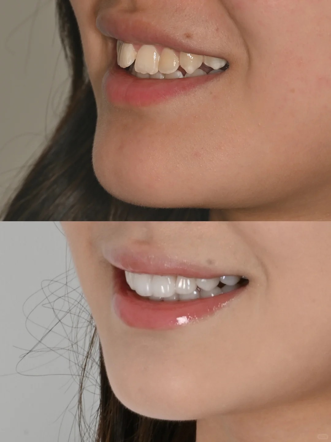 Đừng để răng sứ "làm hỏng nụ cười" khi mắc phải những sai lầm cơ bản này- Ảnh 2. Đừng để răng sứ "làm hỏng nụ cười" khi mắc phải những sai lầm cơ bản này- Ảnh 2.