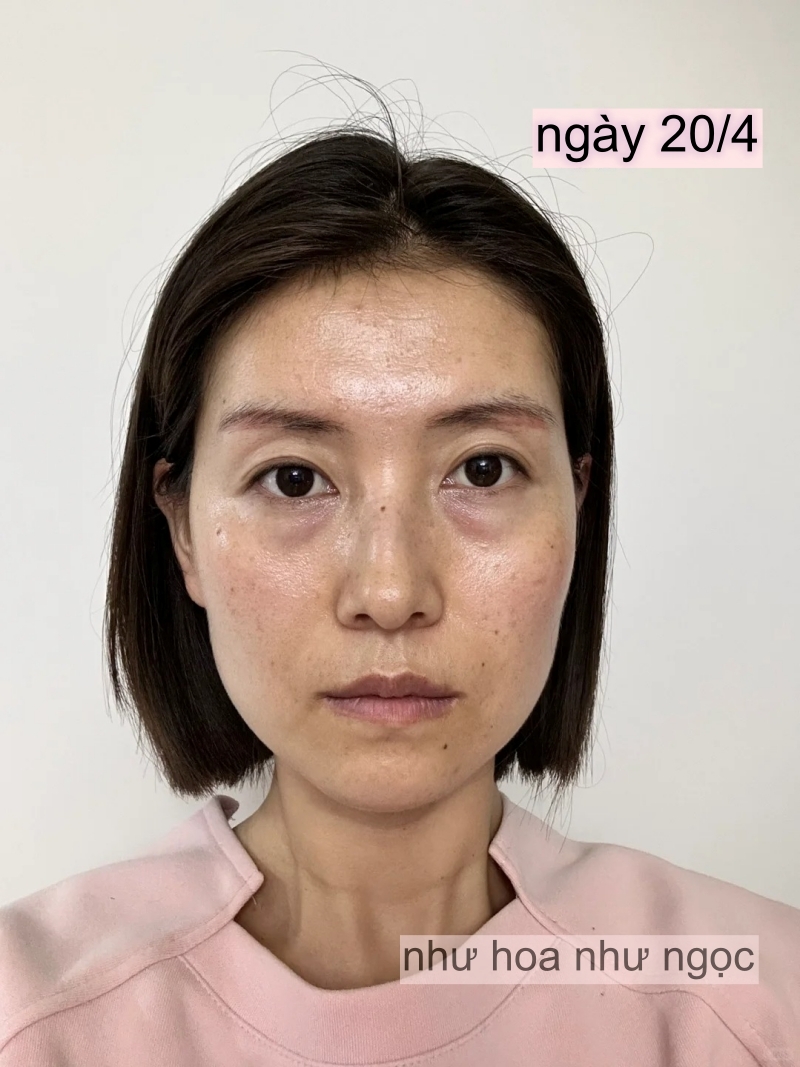 Chụp ảnh mặt mộc hàng ngày trong 1 tháng uống collagen, có điểm này trên mặt thay đổi mà tôi thấy rõ- Ảnh 4. Chụp ảnh mặt mộc hàng ngày trong 1 tháng uống collagen, có điểm này trên mặt thay đổi mà tôi thấy rõ- Ảnh 4.