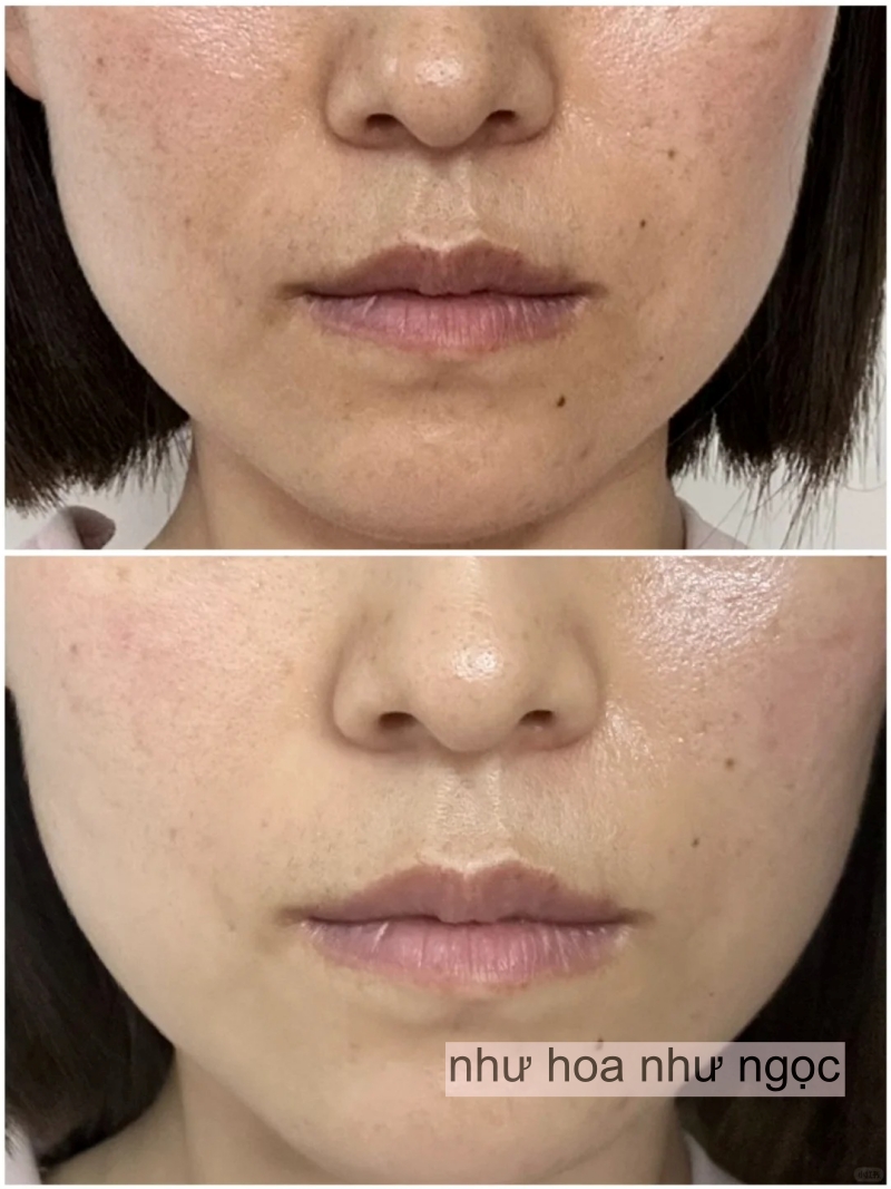 Chụp ảnh mặt mộc hàng ngày trong 1 tháng uống collagen, có điểm này trên mặt thay đổi mà tôi thấy rõ- Ảnh 6. Chụp ảnh mặt mộc hàng ngày trong 1 tháng uống collagen, có điểm này trên mặt thay đổi mà tôi thấy rõ- Ảnh 6.