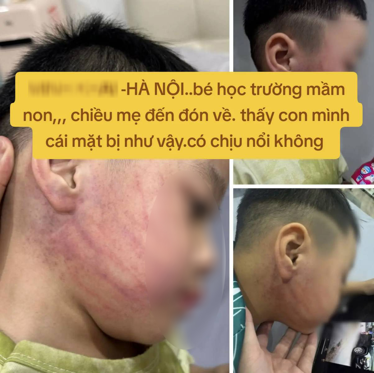 Xôn xao sự việc đón con đi học về thấy in hằn vết tay tấy đỏ khắp mặt, lời giải thích vô lý của giáo viên càng khiến dân tình bức xúc- Ảnh 1.