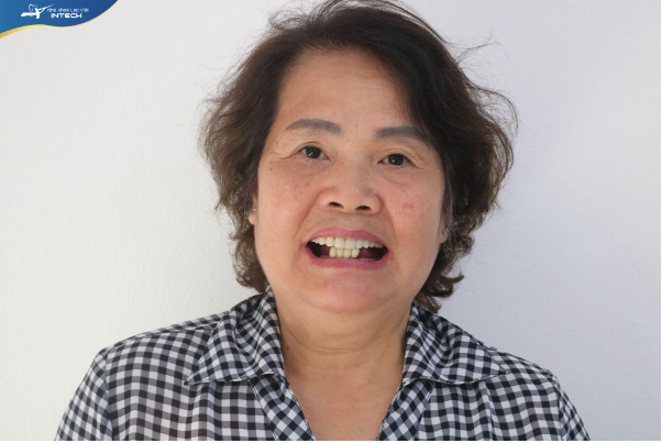Trồng răng: Không phải cha mẹ không muốn, mà vì…!- Ảnh 1. Trồng răng: Không phải cha mẹ không muốn, mà vì…!- Ảnh 1.