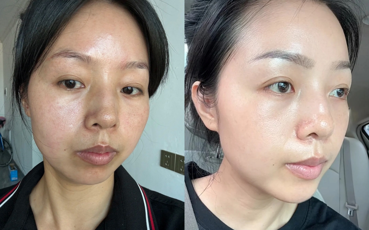Người phụ nữ này mất 2 năm tự dưỡng tại nhà để giúp làn truc tiep bong da hom nay "thoát" nám- Ảnh 1.