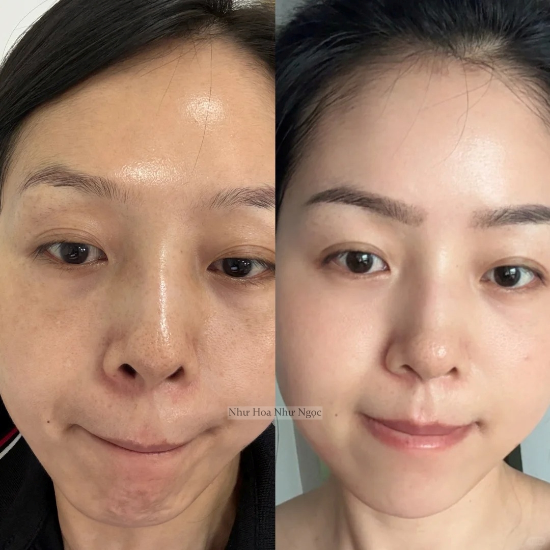 Người phụ nữ này mất 2 năm tự dưỡng tại nhà để giúp làn truc tiep bong da hom nay "thoát" nám- Ảnh 3.