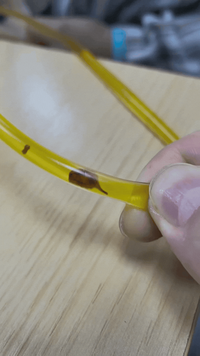 Bác sĩ rùng mình phát hiện thứ đáng sợ trong ống mật của người đàn ông 40 tuổi sau khi bị đau bụng- Ảnh 1. Bác sĩ rùng mình phát hiện thứ đáng sợ trong ống mật của người đàn ông 40 tuổi sau khi bị đau bụng- Ảnh 1.