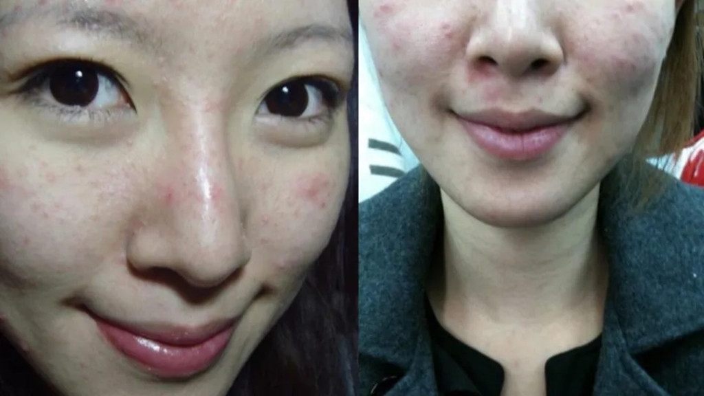 Nữ nghệ sĩ khổ sở vì bệnh da suốt 7 năm, sáng soi gương là bật khóc: Bác sĩ cảnh báo bệnh trứng cá đỏ không chỉ liên quan đến da mặt - Ảnh 2.