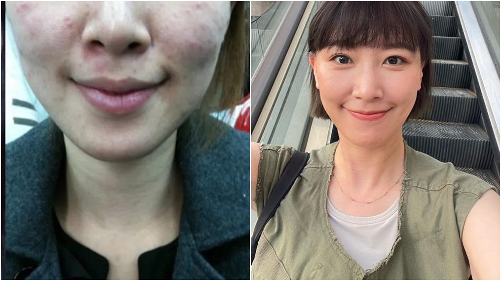 Nữ nghệ sĩ khổ sở vì bệnh da suốt 7 năm, sáng soi gương là bật khóc: Bác sĩ cảnh báo bệnh trứng cá đỏ không chỉ liên quan đến da mặt - Ảnh 1.
