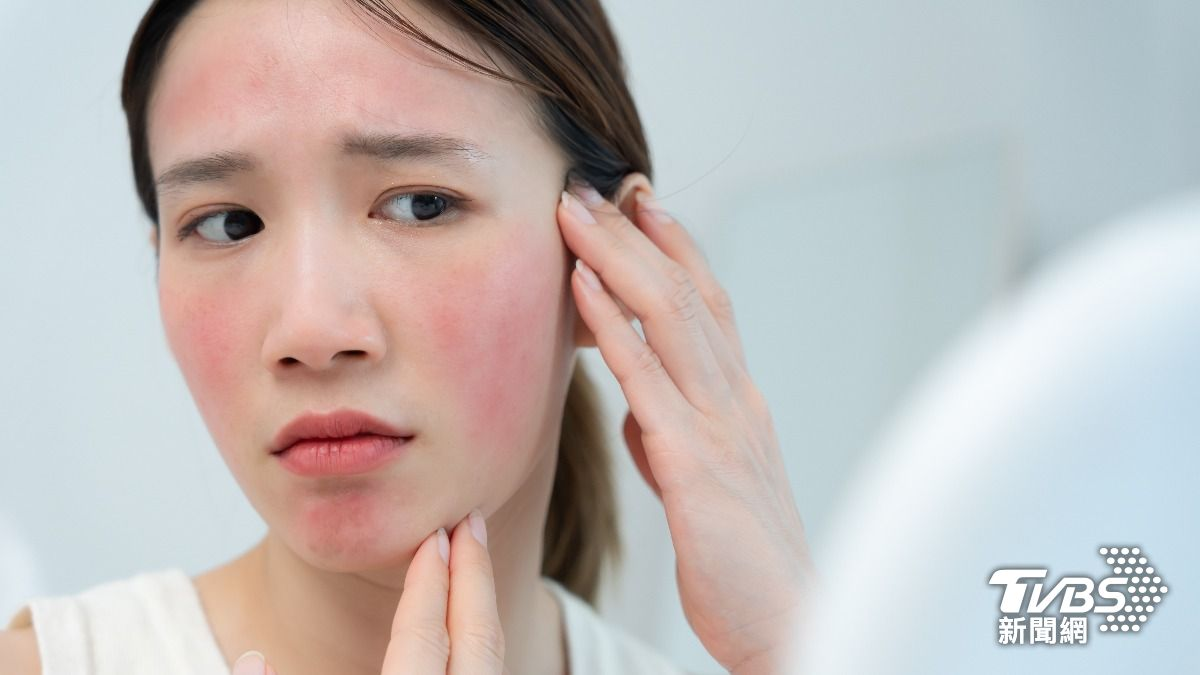 Nữ nghệ sĩ khổ sở vì bệnh da suốt 7 năm, sáng soi gương là bật khóc: Bác sĩ cảnh báo bệnh trứng cá đỏ không chỉ liên quan đến da mặt - Ảnh 3.
