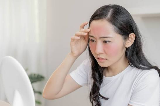Nữ nghệ sĩ khổ sở vì bệnh da suốt 7 năm, sáng soi gương là bật khóc: Bác sĩ cảnh báo bệnh trứng cá đỏ không chỉ liên quan đến da mặt - Ảnh 5.