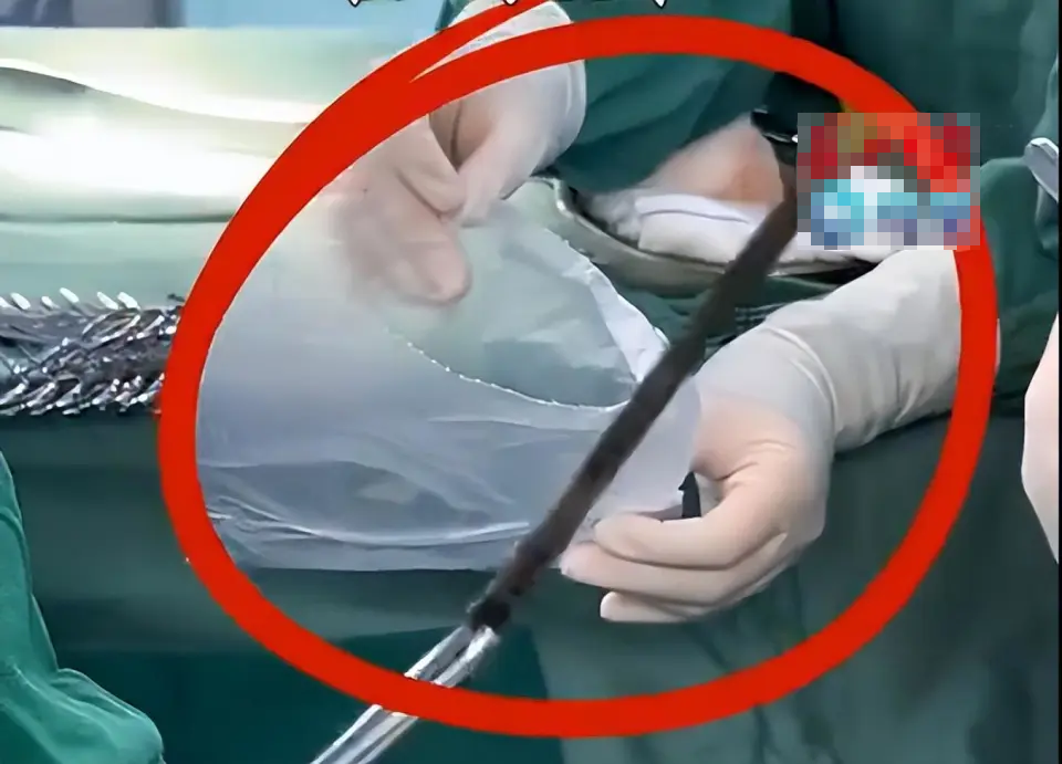 Người đ&agrave;n &ocirc;ng nuốt chiếc đũa d&agrave;i 12cm trong ph&uacute;t bốc đồng, 35 năm sau thứ b&aacute;c sĩ lấy ra l&agrave;&hellip; - Ảnh 1.