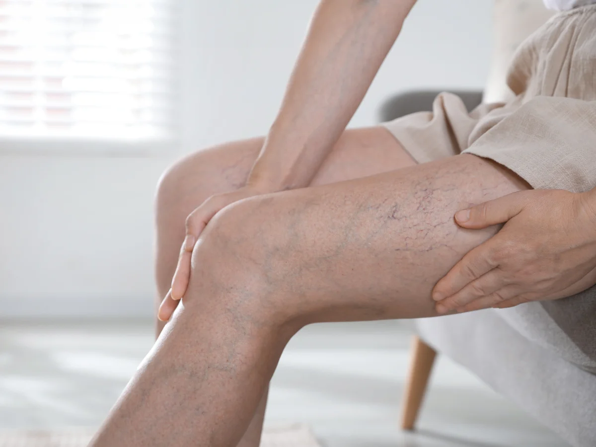 Bị giãn tĩnh mạch ở tuổi 30: Chuyên gia Nhật hướng dẫn cách bảo vệ đôi chân chỉ với 3 phút, ai hay ngồi hoặc đứng trong thời gian dài nên học - Ảnh 1.