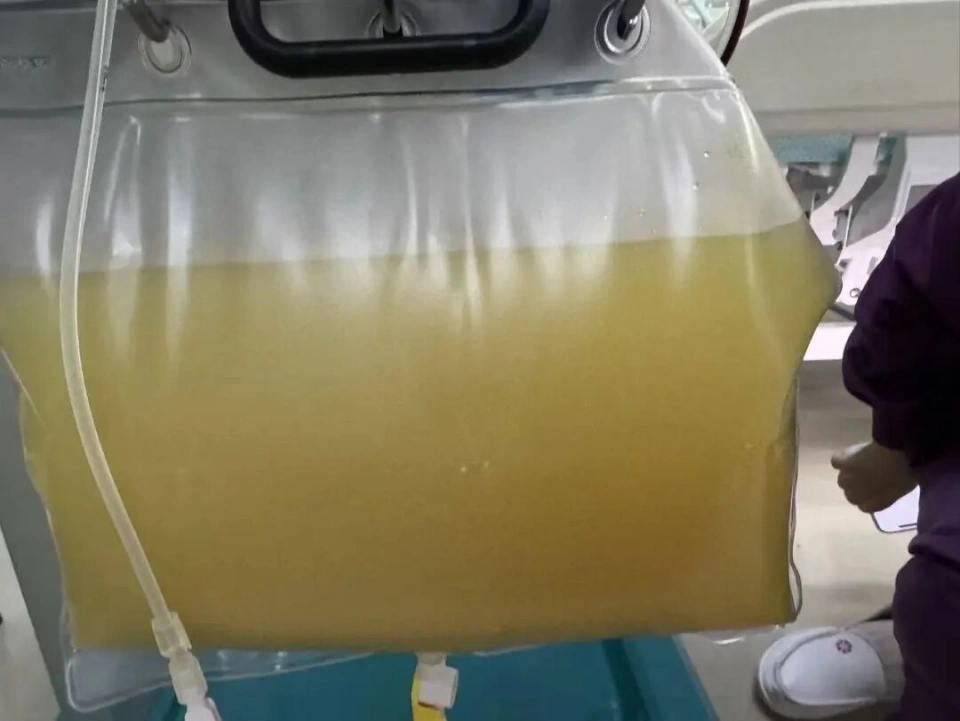 Người phụ nữ 38 tuổi đau bụng dữ dội, m&aacute;u trắng đục như sữa, b&aacute;c sĩ cảnh b&aacute;o nguy&ecirc;n nh&acirc;n từ th&oacute;i quen ăn uống quen thuộc- Ảnh 2.