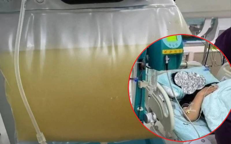 Người phụ nữ 38 tuổi đau bụng dữ dội, m&aacute;u trắng đục như sữa, b&aacute;c sĩ cảnh b&aacute;o nguy&ecirc;n nh&acirc;n từ th&oacute;i quen ăn uống quen thuộc- Ảnh 3.