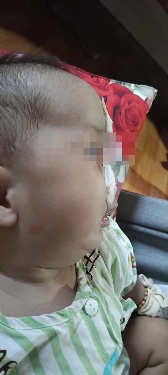 Bệnh viện Nhi đồng 1 điều trị th&agrave;nh c&ocirc;ng trẻ sơ sinh mắc hội chứng Pierre Robin bằng kỹ thuật ti&ecirc;n tiến - Ảnh 1.