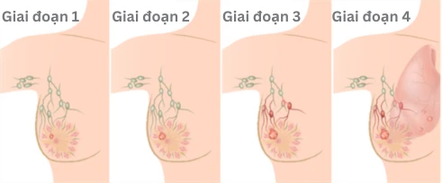 Mắc ung thư vú giai đoạn 4 ở tuổi 34, cuộc sống của cựu nữ chính The Bachelorette sau 2 năm khiến nhiều người xúc động- Ảnh 7.