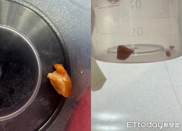 Bà cho cháu trai 1 tuổi ăn cả một hạt lạc… và phổi của cháu bắt đầu xẹp! Bác sĩ bức xúc: Đây không biết là trường hợp thứ bao nhiêu! - Ảnh 1.