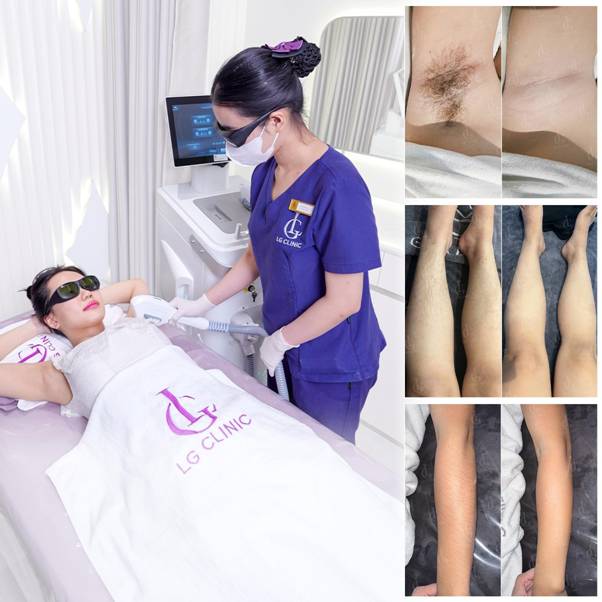 5 yếu tố đứng sau vị thế dẫn đầu của LG Clinic trong lĩnh vực triệt l&ocirc;ng tại Việt Nam - Ảnh 2.