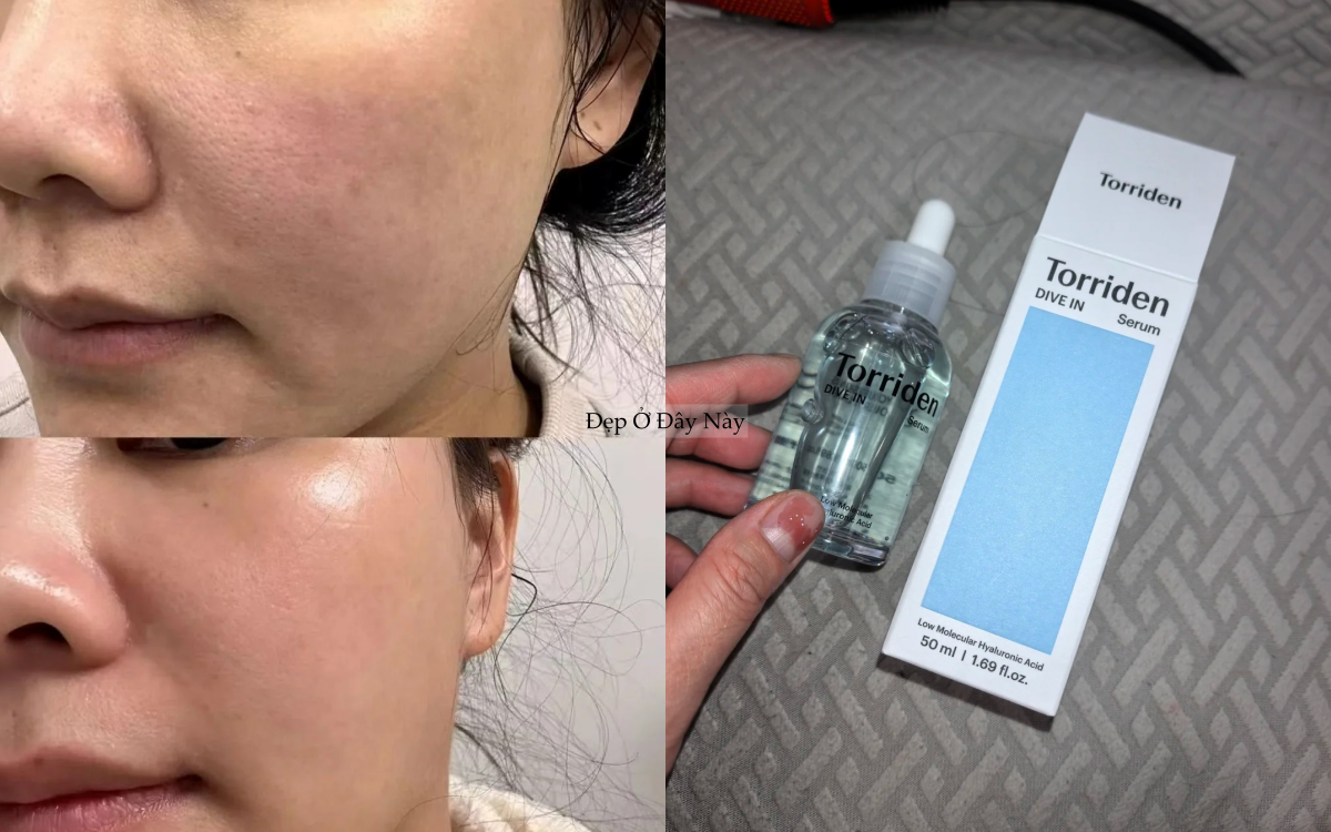 Chuy&ecirc;n gia chỉ ra: C&oacute; tới 4 loại lỗ ch&acirc;n l&ocirc;ng to v&agrave; c&aacute;ch khắc phục hiệu quả nhất - Ảnh 3.