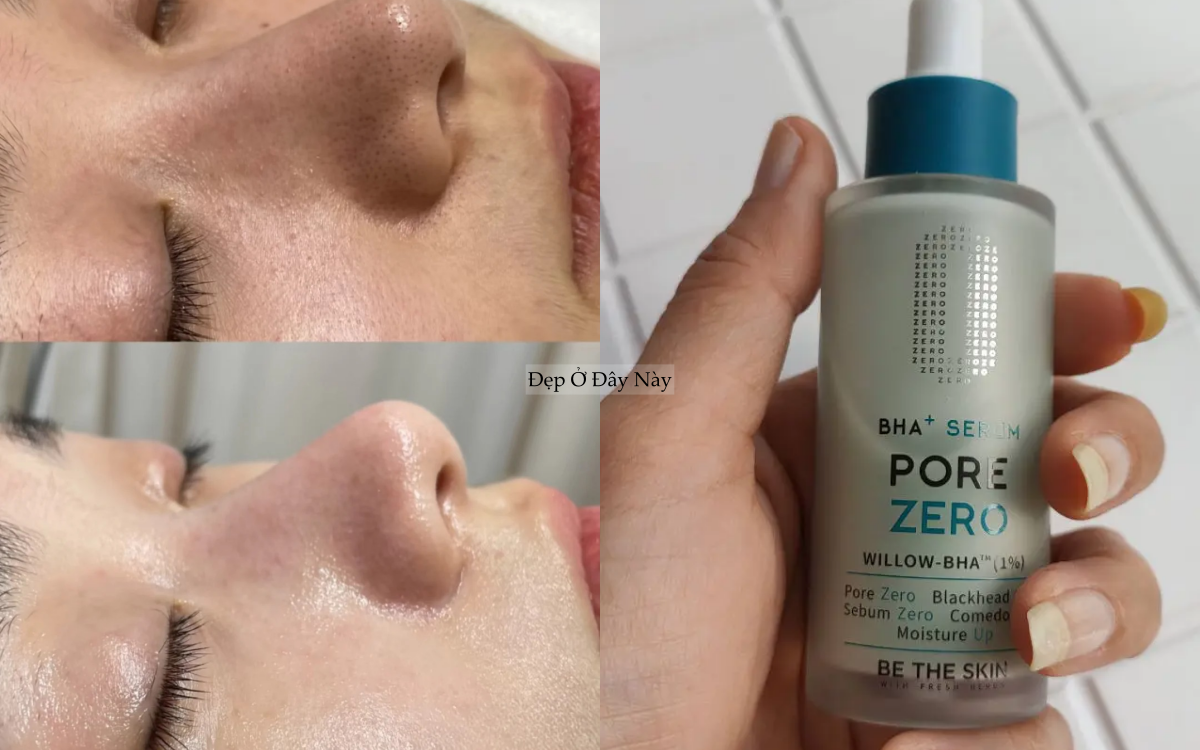 Chuy&ecirc;n gia chỉ ra: C&oacute; tới 4 loại lỗ ch&acirc;n l&ocirc;ng to v&agrave; c&aacute;ch khắc phục hiệu quả nhất - Ảnh 4.