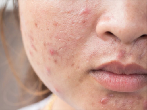 Routine chăm sóc da dầu mụn đơn giản tại nhà: 3 bước khoa học cùng Actidem - Ảnh 1. Routine chăm sóc da dầu mụn đơn giản tại nhà: 3 bước khoa học cùng Actidem - Ảnh 1.