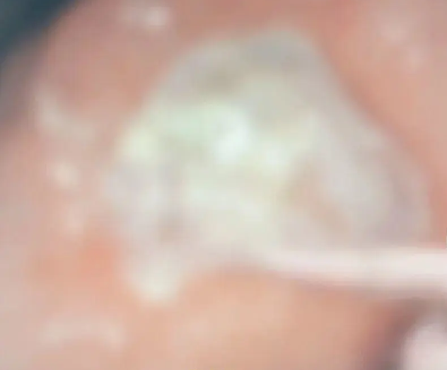 Ăn 1 loại rau khi đ&oacute;i bụng, người đ&agrave;n &ocirc;ng nhập viện v&igrave; xuất huyết dạ d&agrave;y, b&aacute;c sĩ nhăn mặt: "L&agrave;m thế kh&aacute;c g&igrave; cọ sắt ch&agrave; th&agrave;nh dạ d&agrave;y?"- Ảnh 2.