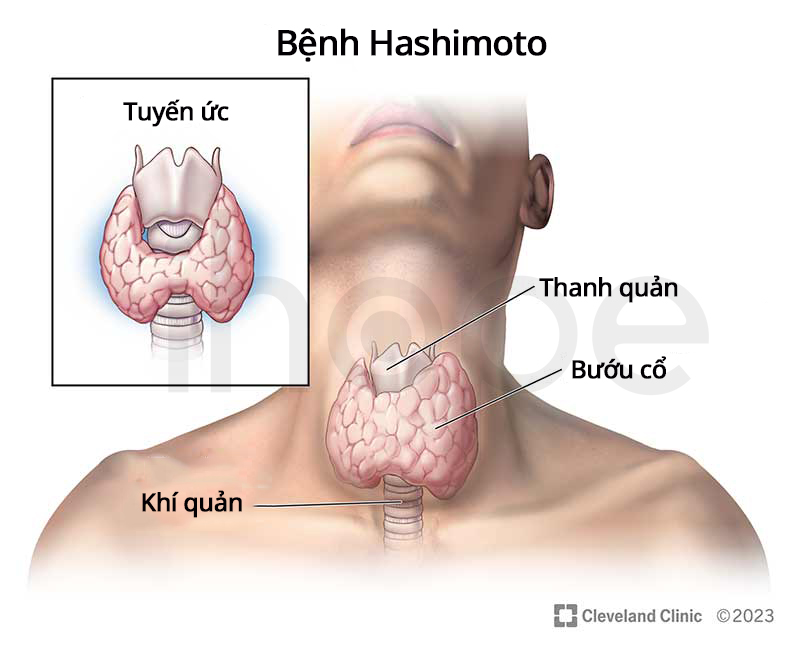 Nữ diễn vi&ecirc;n 36 tuổi tiết lộ "mắc bệnh Hashimoto", phải từ bỏ đồ ăn ngo&agrave;i để giữ sức khỏe: Căn bệnh thường gặp ở phụ nữ, kh&ocirc;ng thể chữa khỏi - Ảnh 4.